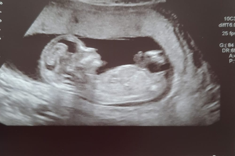 A scan of my uterus in April 2021 at 12 weeks of pregnancy.